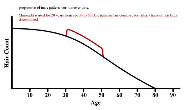Graph demonstrating how discontinuing minoxidil causes any gains to be lost