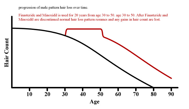 Graph of what happens when Finasteride and Minoxidil is discontinued